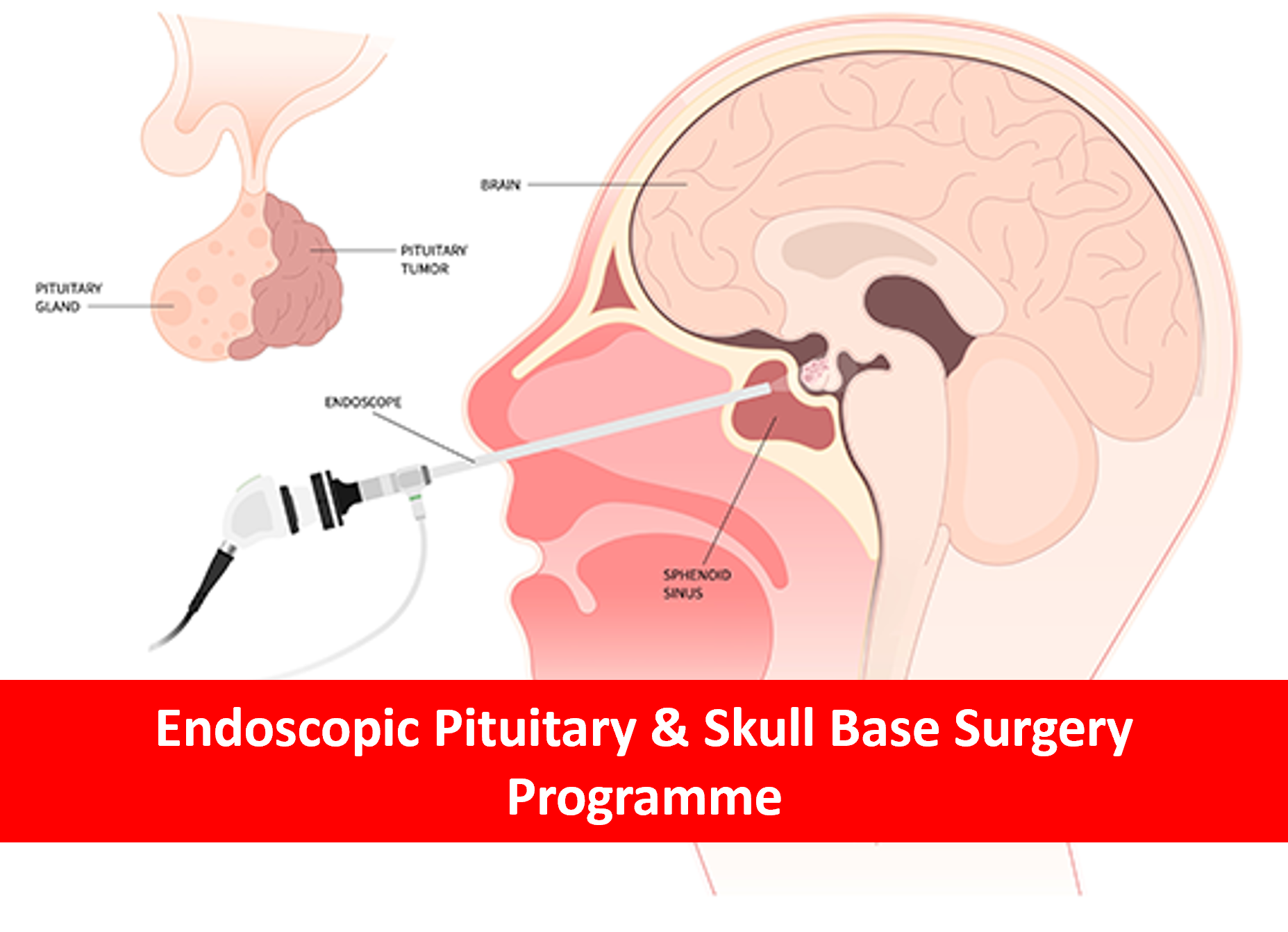 Endoscopic Pituitary and Skull Base Surgery Programme