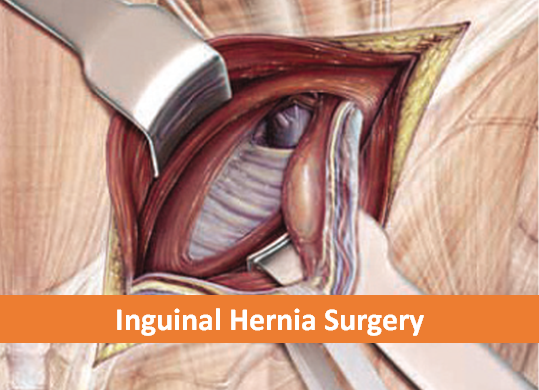 Inguinal Hernia Surgery label
