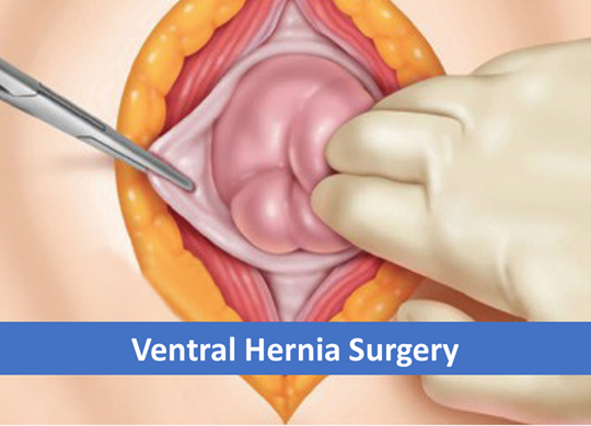 Ventral Hernia Surgery label