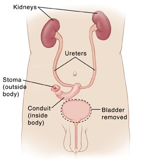 Services for Bladder Cancer