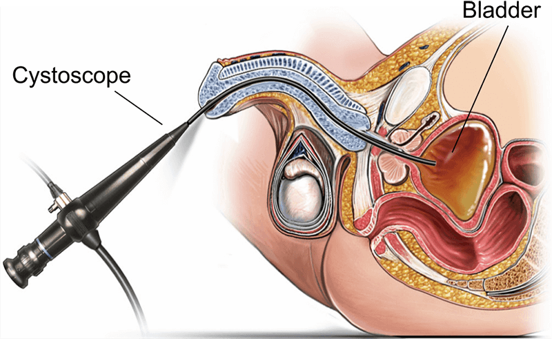 Services for Bladder Cancer