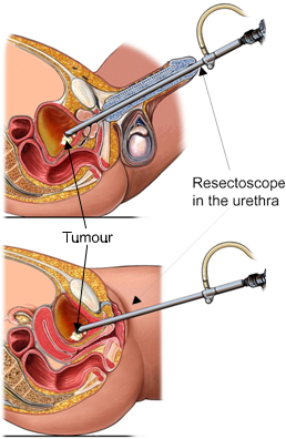 Services for Bladder Cancer