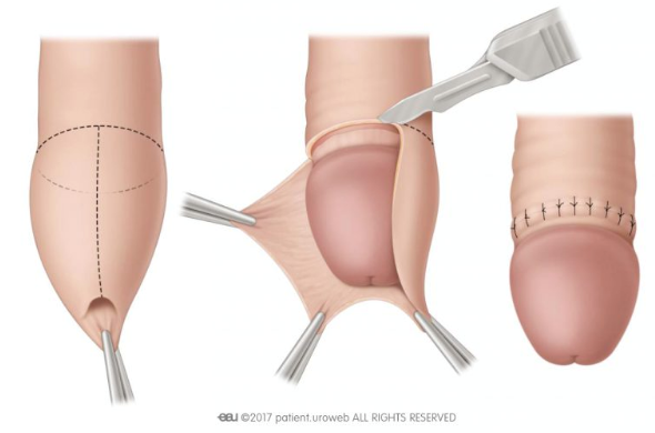 Services for Circumcision