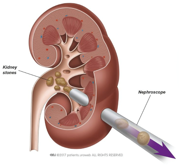 Services for Kidney Stones