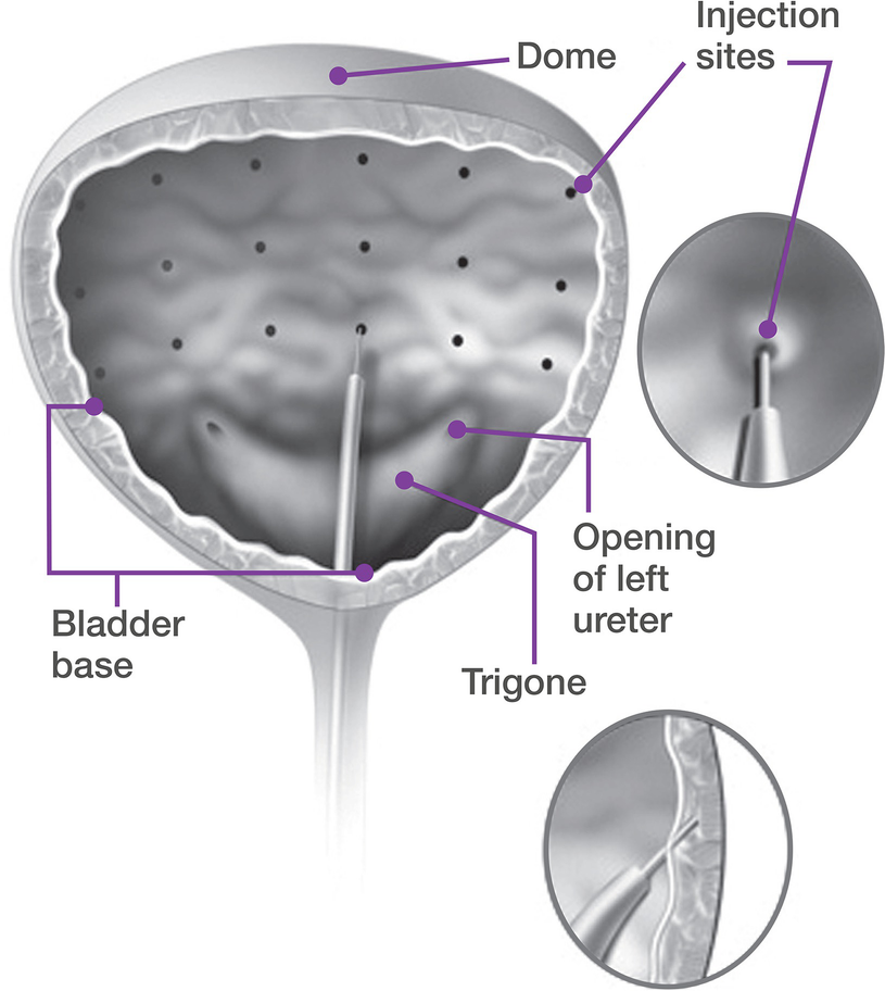 Services for Overactive Bladder