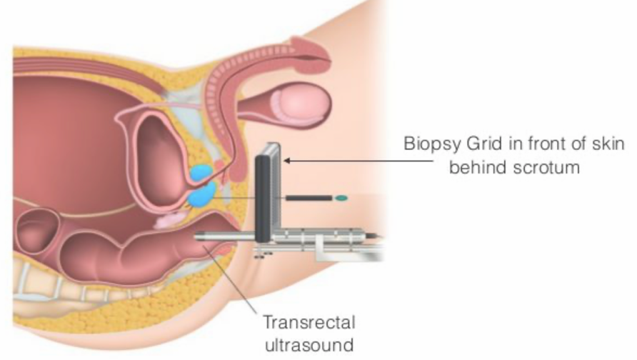 Services for Prostate Cancer