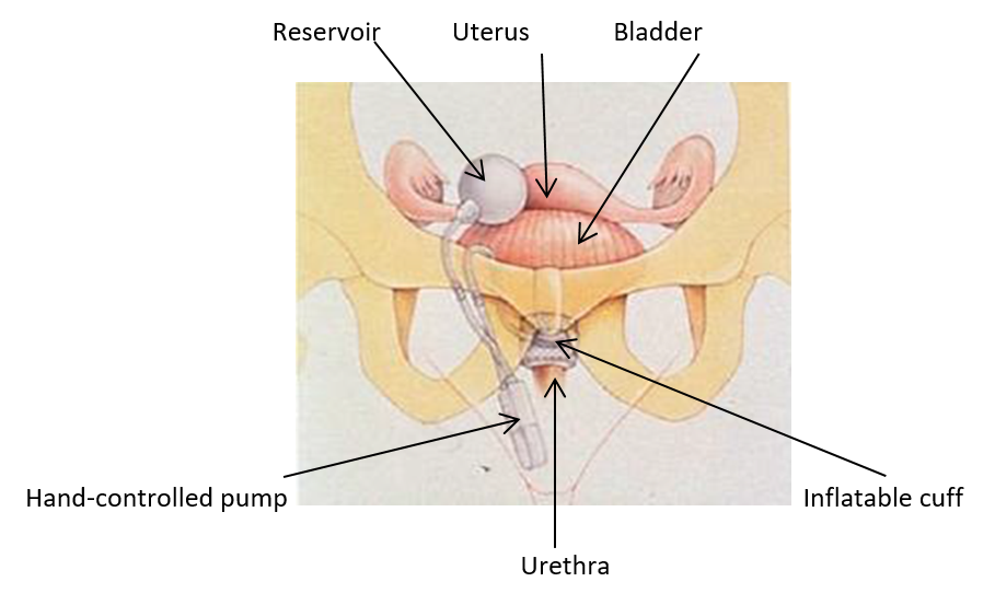 Services for Urinary Incontinence