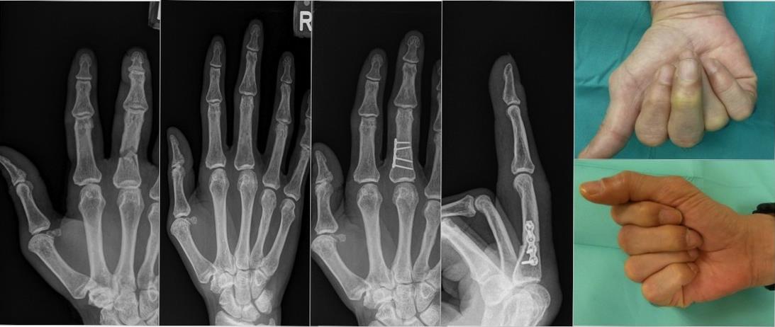 corrective surgery in a mal-united fracture of the phalanx of the middle finger.