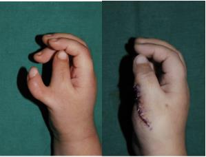 Corrective surgery for thumb duplication