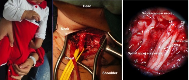 Infant with Erb palsy with adducted and internally rotated left upper limb