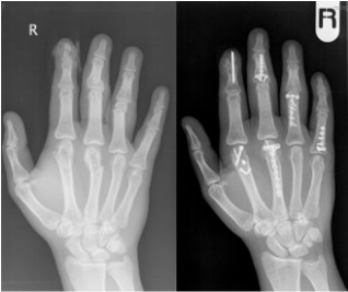 Open reduction and internal fixation of multiple fractures