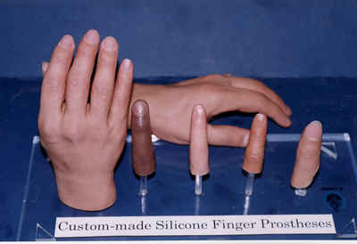 Custom made silicone finger prostheses