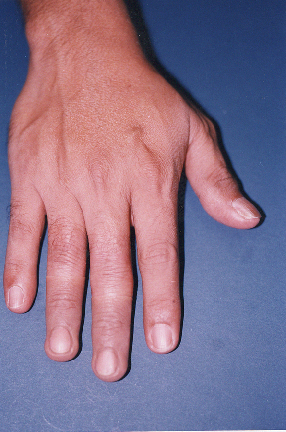 A patient with right middle and ring fingertip amputation - after fitting with thimble/cap-type prosthesis