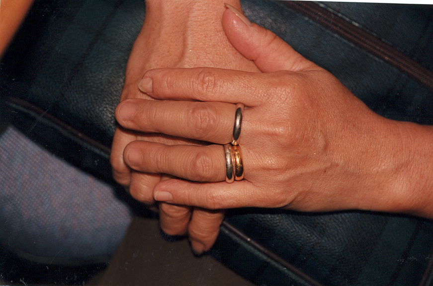 A patient fitted with custom-moulded finger prosthesis on the left amputated middle and ring fingers