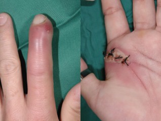 Pulp abscess (left) and post-operative infection (right)