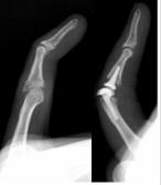 Replacement of a post traumatic arthritic proximal interphalangeal joint