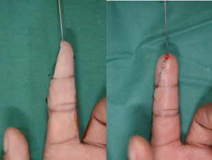 Microsurgical replantation of an amputated fingertip