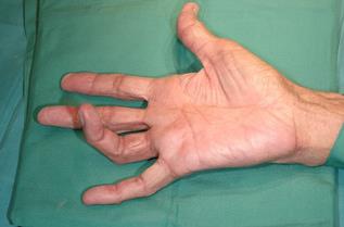 Typical bent posture observed in a trigger finger