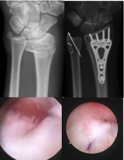 Open reduction and internal fixation of a distal radius and ulnar styloid fracture (top) Arthroscopic repair of TFCC injury (bottom)