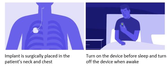 Device implanted in the body