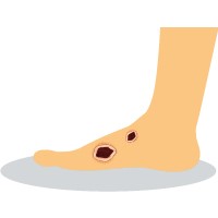 Diabetic Foot