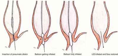 Balloon Dilatation