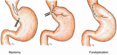 Myotomy - Fundoplication