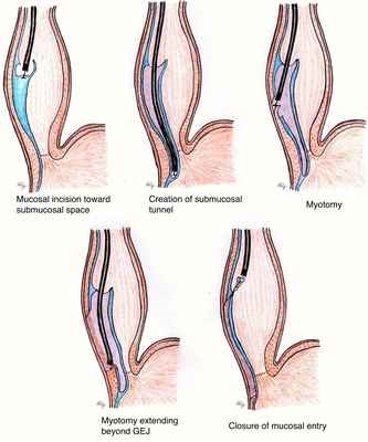 Peroral Endoscopic Myotomy (POEM)