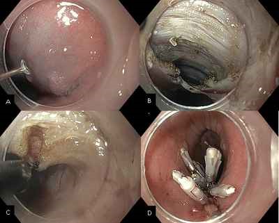 Endoscopic view