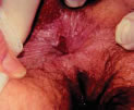 Fissure examination