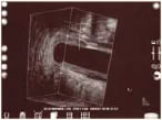 Endoanal Ultrasound Fig. 2