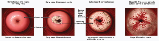 Cervical cancer spread and stages