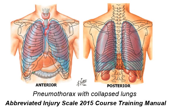 Pneumothorax with collapsed lungs