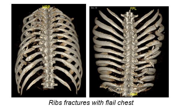 Rib fractures with flail chest