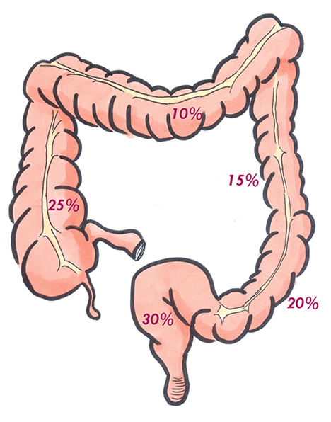 Colorectal Cancer