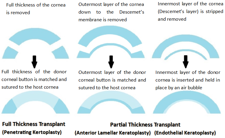What Is a Corneal Transplant