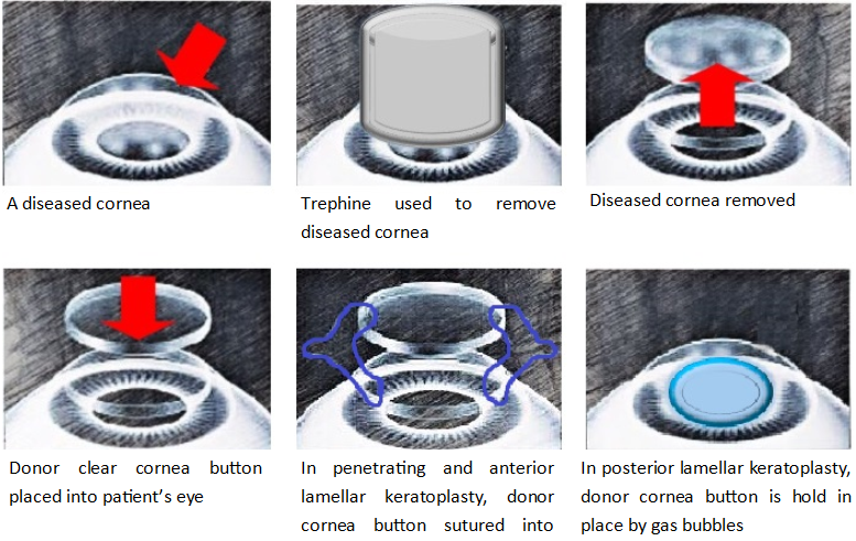 How is a cornea transplant performed