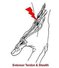 Extensor Tendon & Shealth