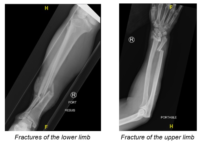 Fractures of the lower limb and upper limb