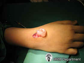 Surgical excision of a dorsal wrist ganglion
