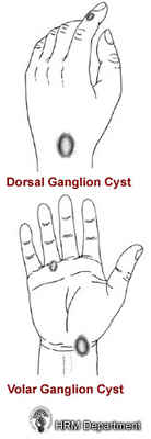 Dorsal and Volar Ganglion Cyst