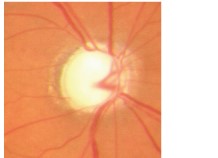 Optic disc in a patient with glaucoma