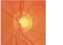 Normal optic disc