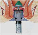 Stapled hemorrhoidectomy - Fig 1