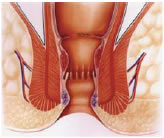 Stapled hemorrhoidectomy - Fig 2