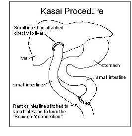 Kasai Procedure