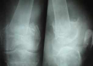 Osteoporotic knee fracture in an elderly patient