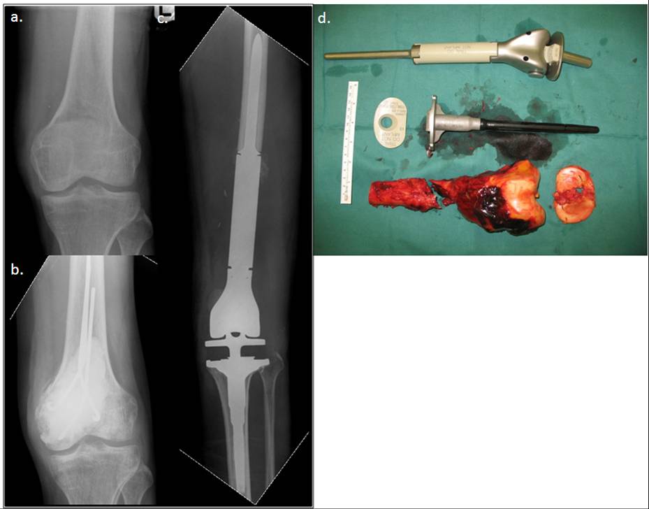 Primary cancers of the bones