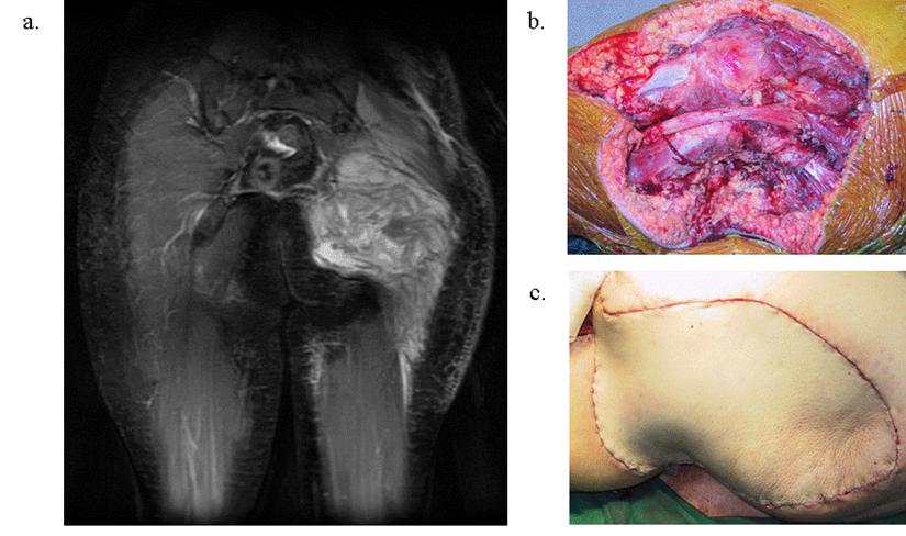 Primary cancers of the soft tissues