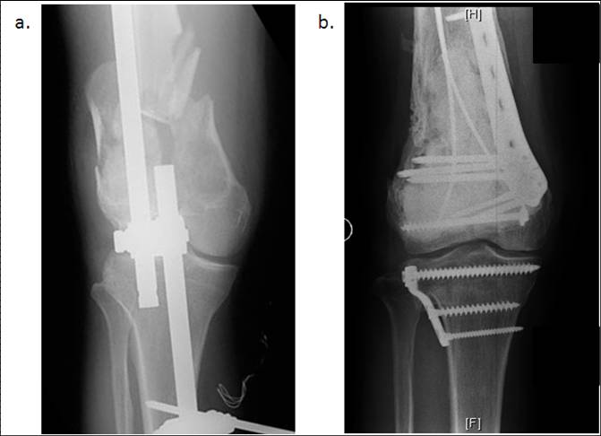 Benign tumours of the bones and soft tissues